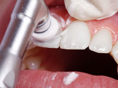 Zahnprophylaxe Bleaching professionelle Zahnreinigung in München Schwabing